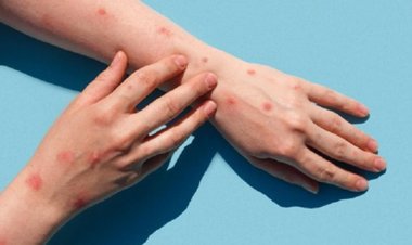 Alexandru Rafila, sfaturi pentru evitarea contaminării cu variola maimuței